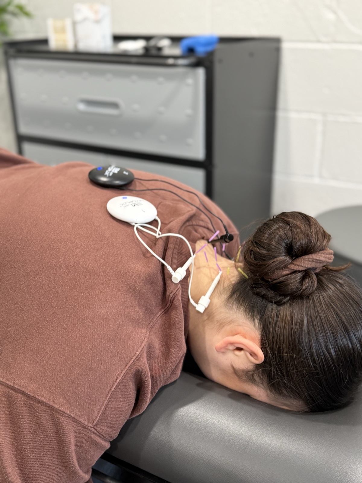 Dry needling treatment in progress at Connected Chiropractic & Wellness